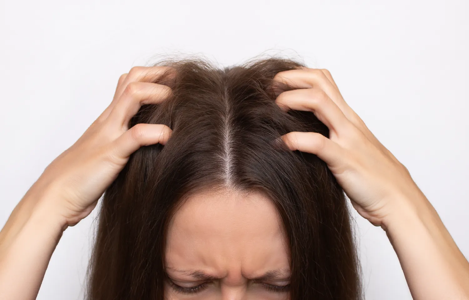 Mătreață și păr gras: cauzele ciupercii seboreice și tratament eficient