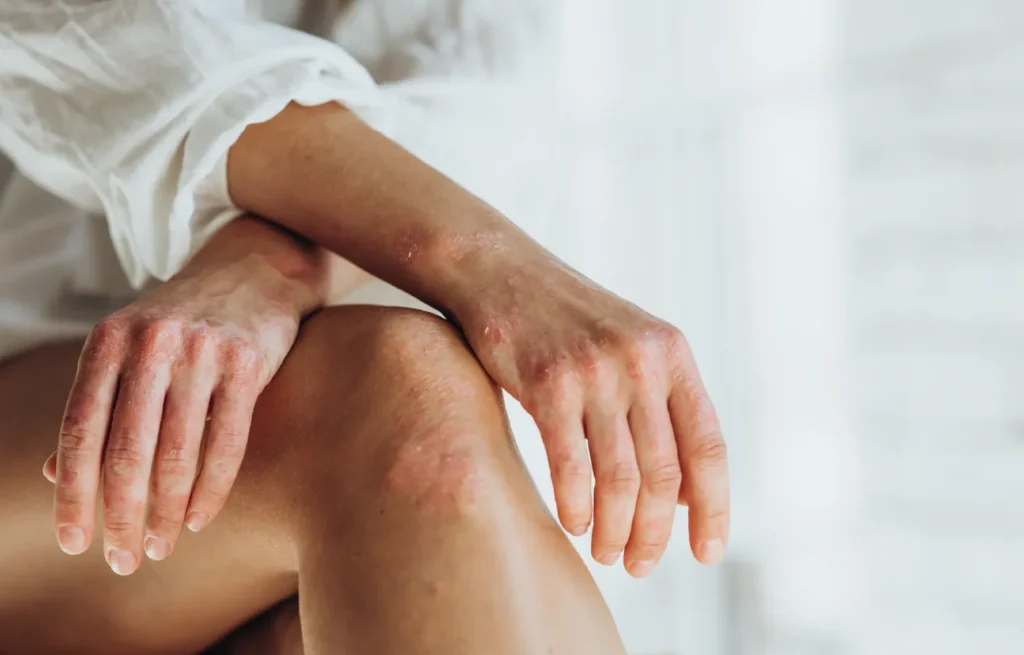 Femeie cu psoriazis pe mâini și genunchi cu leziuni inflamatorii și descuamare