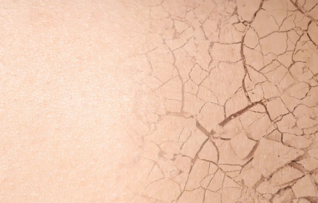 Piele uscată și crăpată - deshidratare severă care necesită tratament hidratant intensiv