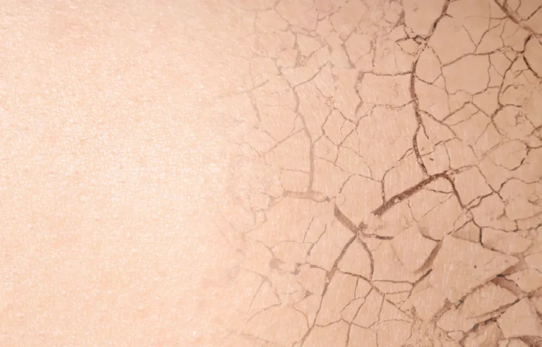 Piele uscată și crăpată - deshidratare severă care necesită tratament hidratant intensiv